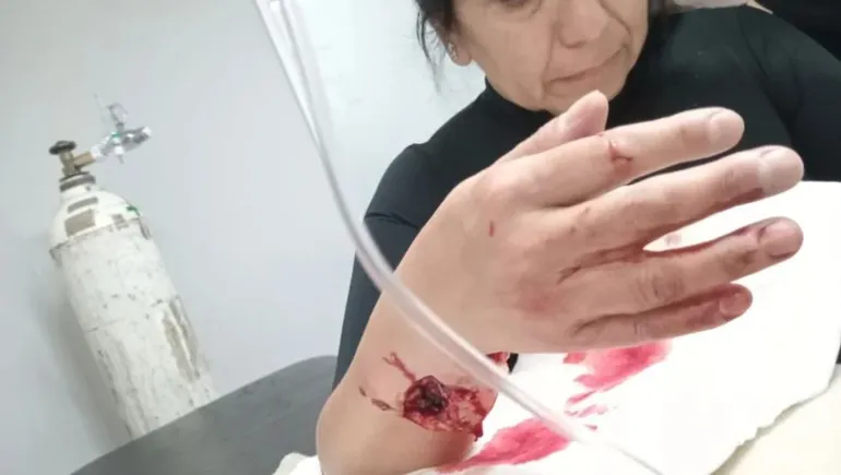 Río Gallegos: Salió a correr y la atacó el pitbull de un adiestrador